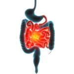 Darmentzündung shutterstock_390898885.jpg