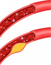 Arteriosklerose © Teguh Mujiono shutterstock