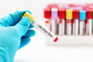  LDL Test Cholesterin © Jarun Ontakrai shutterstock